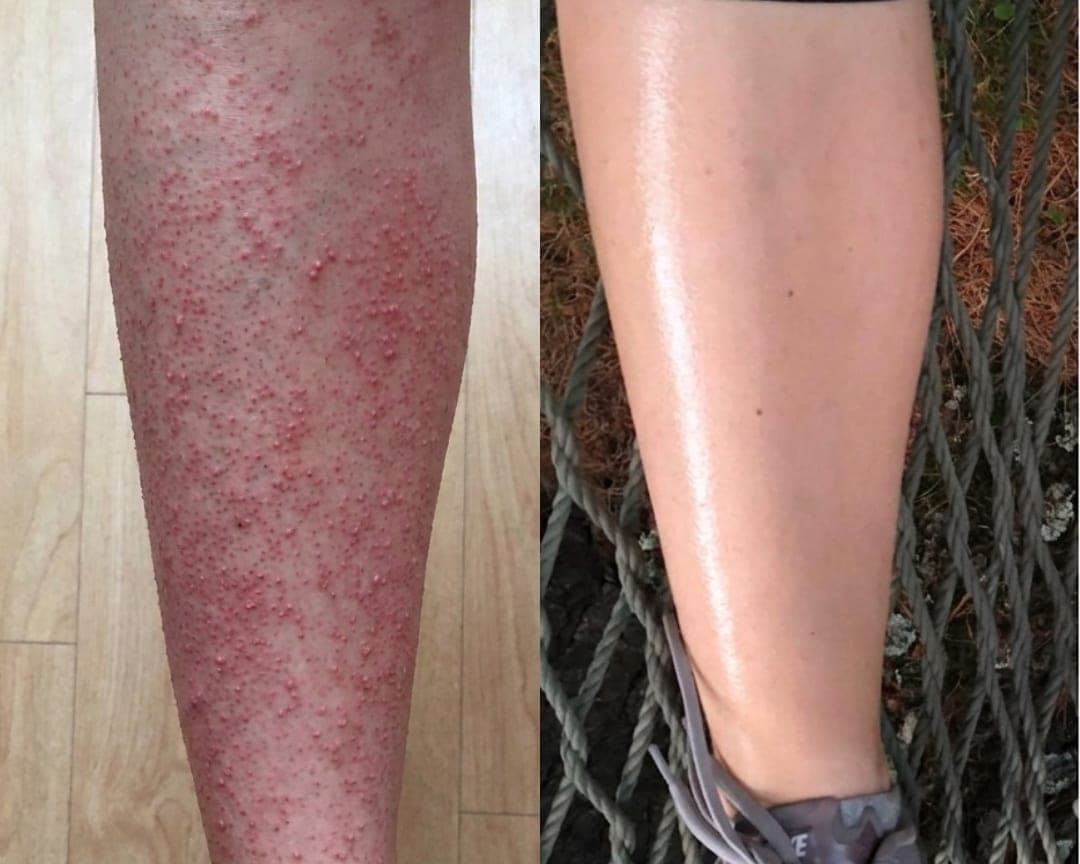 Pernas: antes e ao fim de 10 dias